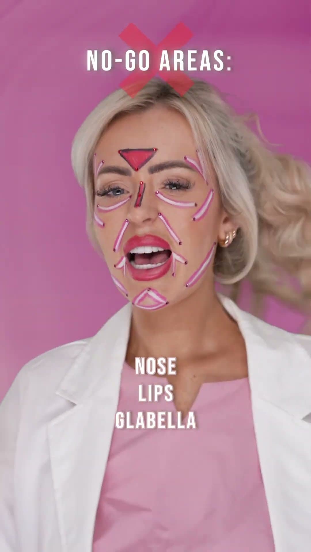 Presenter with Botox injection areas marked on her face